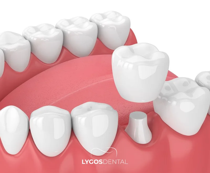 What Is a Zirconium Dental Crown?