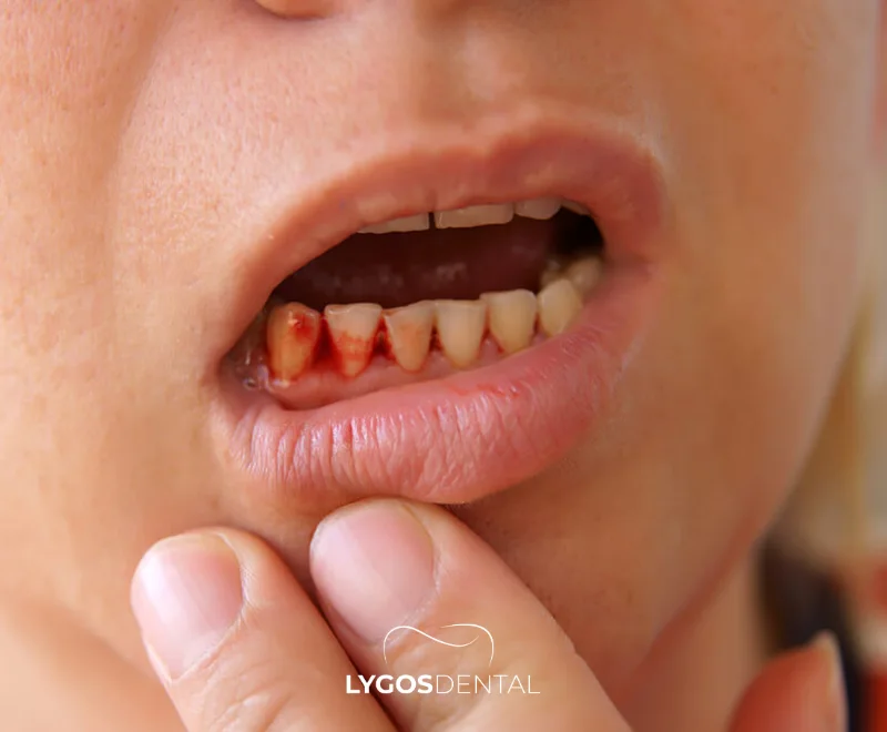 Une dent infectée peut-elle être extraite ? | LYGOS DENTAL