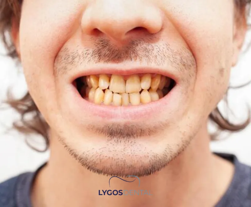 The Effects of Stress on Dental Health | LYGOS DENTAL