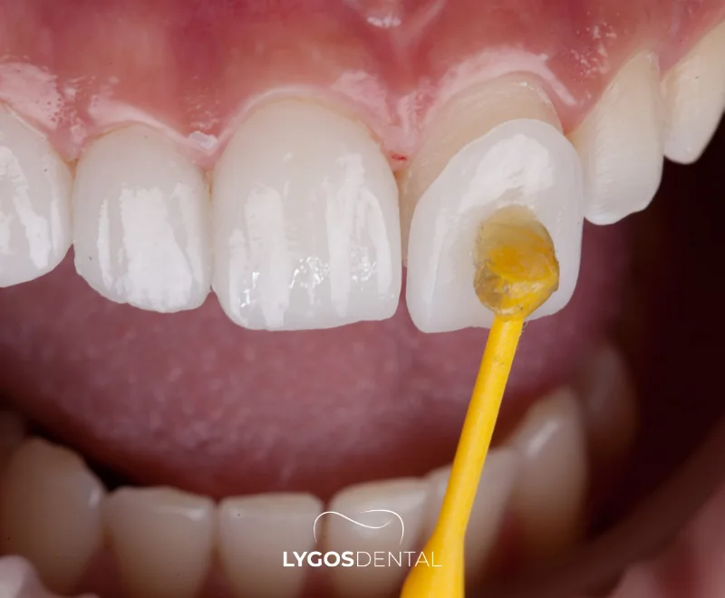 Turkey Dental Veneer Prices 2026 | LYGOS DENTAL