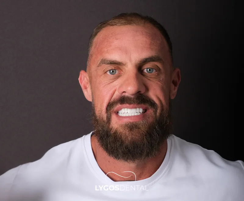 Hollywood Smile Turkey vs Dubai | LYGOS DENTAL