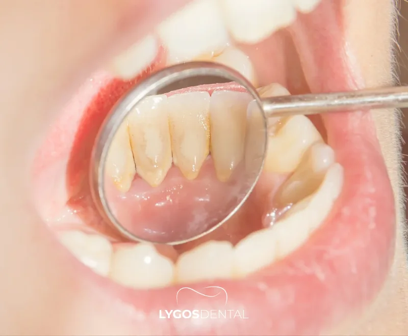 Diş Taşı Gidermenin 10 Doğal Yolu | LYGOS DENTAL 1 What is Tartar
