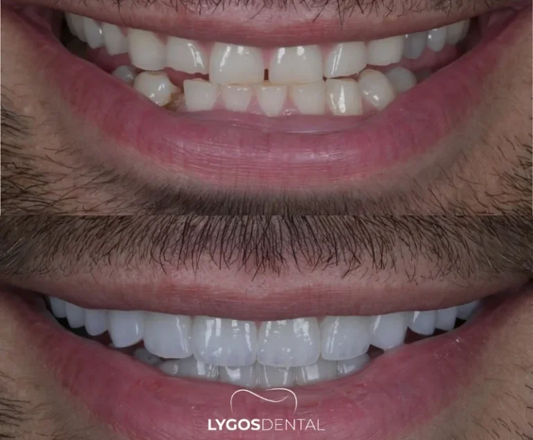 ¿Es seguro hacerse implantes dentales en Turquía? | LYGOS DENTAL