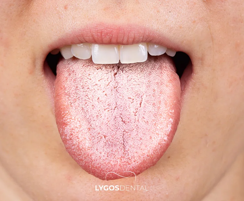 What Is Dry Mouth?