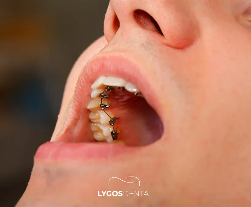What Are Lingual Braces?