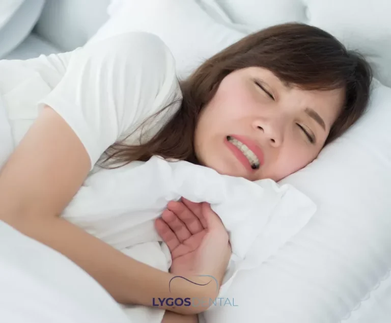 How Long Do Veneers Last? | LYGOS DENTAL 2 How Long Do Veneers Last? | LYGOS DENTAL