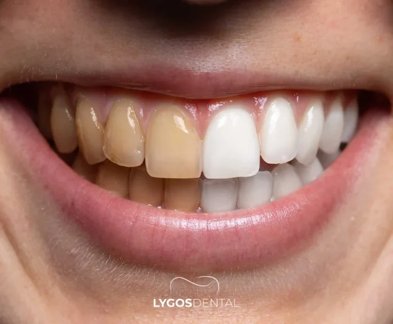 How Long Do Veneers Last? | LYGOS DENTAL 3 How Long Do Veneers Last? | LYGOS DENTAL