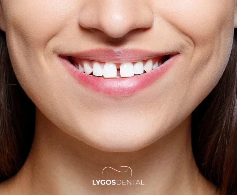 All About Invisible Braces | LYGOS DENTAL