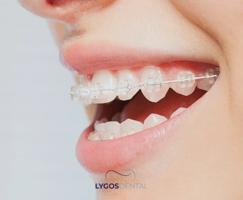 All About Invisible Braces | LYGOS DENTAL