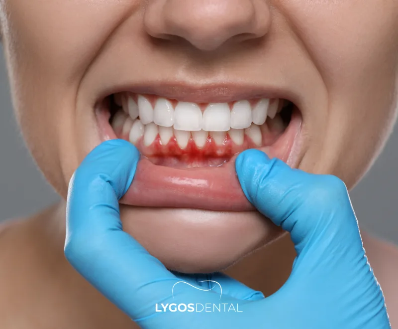 Sensitivity After Tartar Cleaning | LYGOS DENTAL 13 Sensitivity After Tartar Cleaning