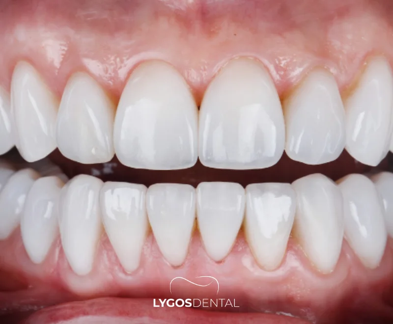 Zirconium vs Porcelain Veneers | LYGOS DENTAL