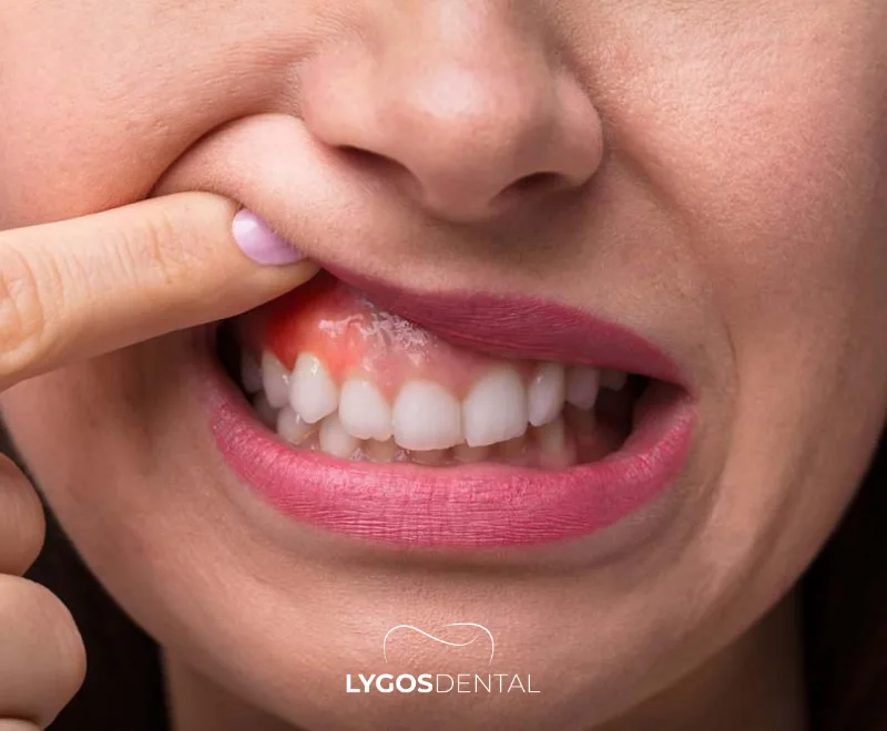 The Impact of Rheumatic Diseases on Oral Health | LYGOS DENTAL