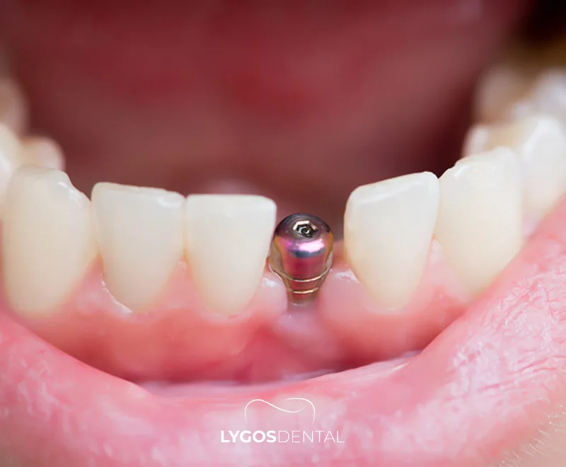 In Which Situations Is a Bone Graft Applied? | LYGOS DENTAL