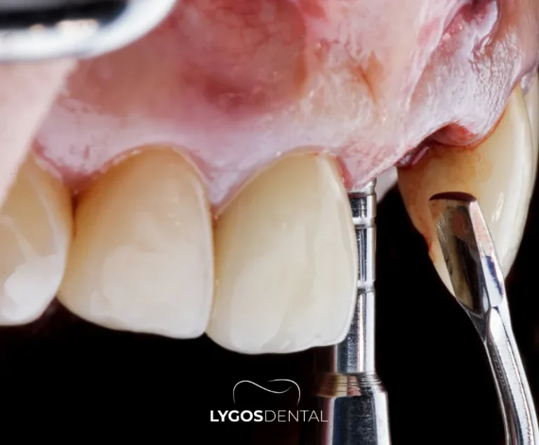 In Which Situations Is a Bone Graft Applied? | LYGOS DENTAL