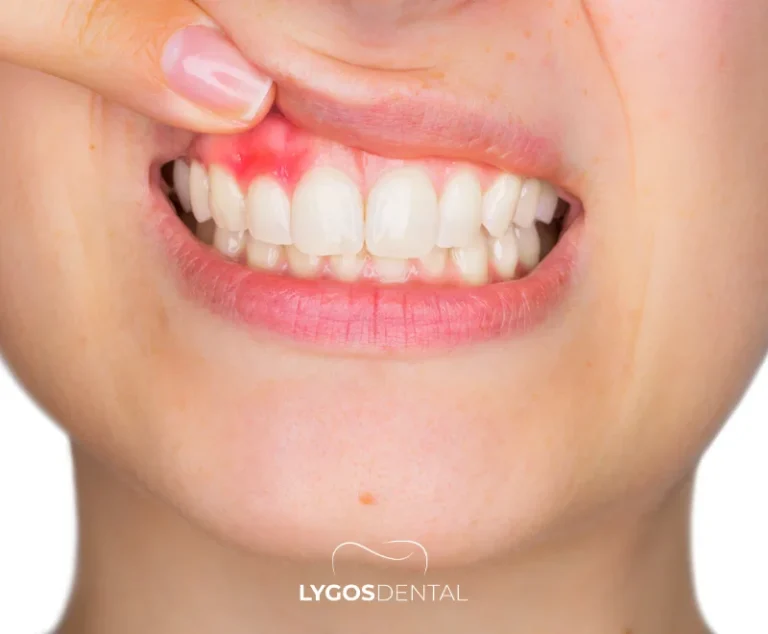In Which Situations Is a Bone Graft Applied? | LYGOS DENTAL