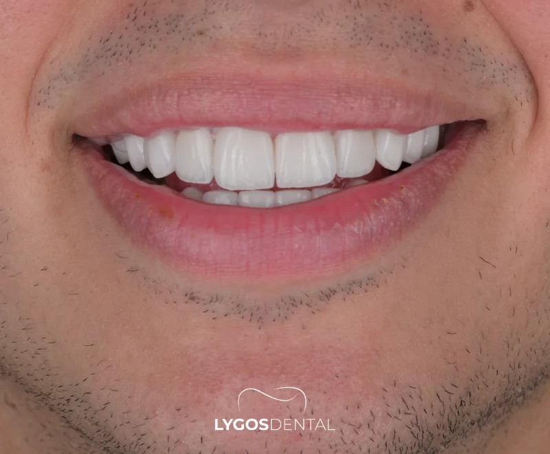 Emax Veneer 2026 | LYGOS DENTAL