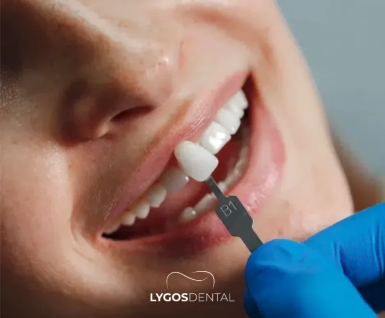 Emax Veneer 2026 | LYGOS DENTAL