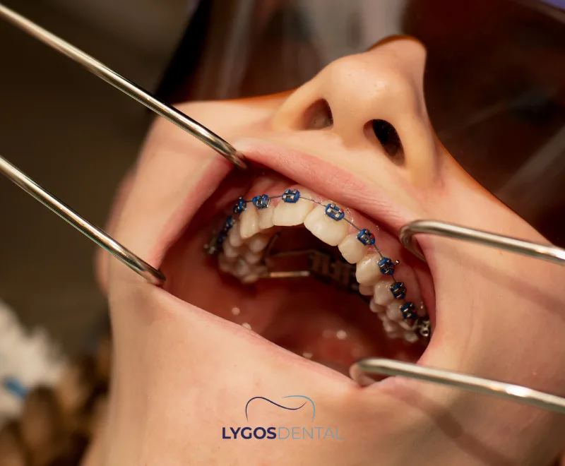 What to Eat During Orthodontic Treatment | LYGOS DENTAL