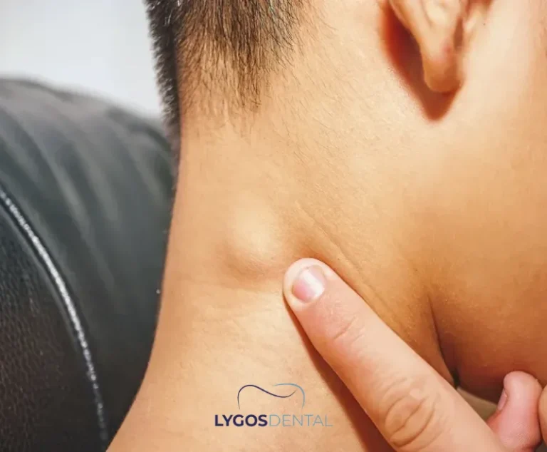 Swelling After Wisdom Tooth Extraction | LYGOS DENTAL 21 Swelling After Wisdom Tooth Extraction | LYGOS DENTAL