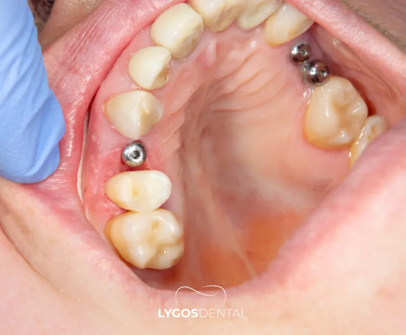 Infection Risks After Dental Implants | LYGOS DENTAL
