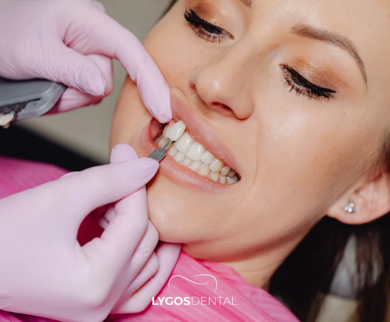 Porcelain vs Laminate Veneers | LYGOS DENTAL 10 Porcelain vs Laminate Veneers | LYGOS DENTAL