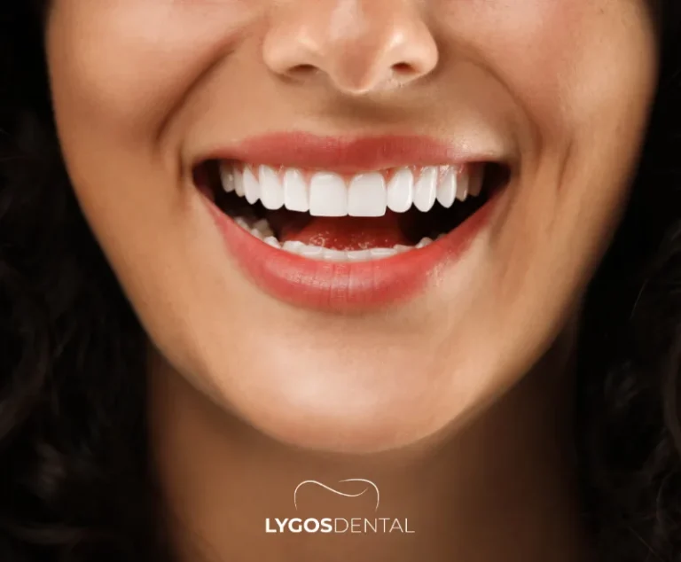 Porcelain vs Laminate Veneers | LYGOS DENTAL 11 Porcelain vs Laminate Veneers | LYGOS DENTAL