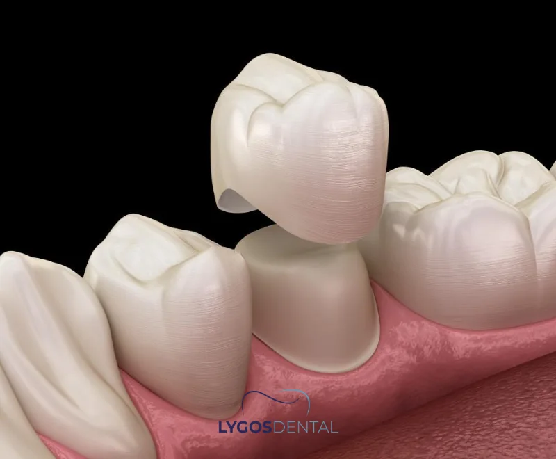 Sensitivity After Zirconium Crowns | LYGOS DENTAL 1 What Is a Zirconium Crown?