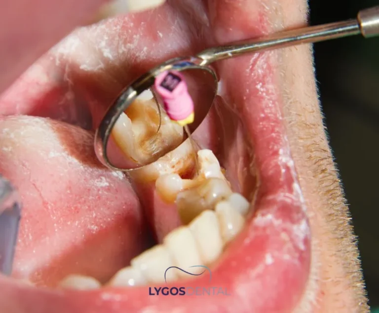 What Helps Toothache Caused by Cavities? | LYGOS DENTAL 27 What Helps Toothache Caused by Cavities? | LYGOS DENTAL