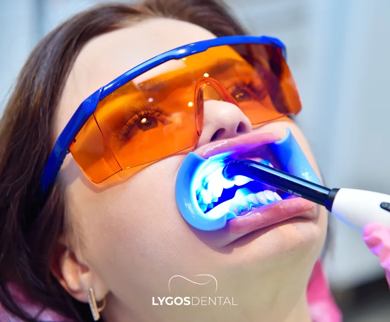 Laser Teeth Whitening | LYGOS DENTAL 16 Laser Teeth Whitening | LYGOS DENTAL