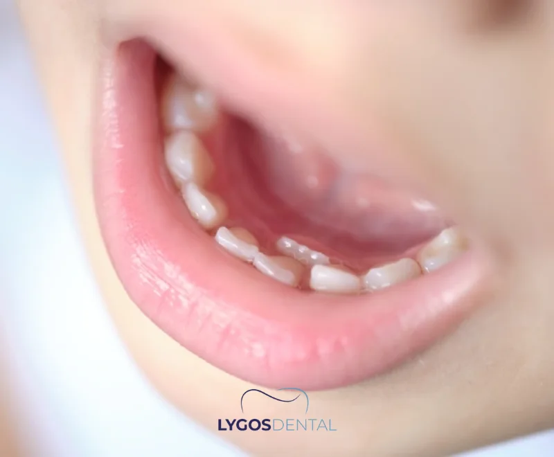 Permanent Tooth Before Baby Tooth Falls Out | LYGOS DENTAL 10 Permanent Tooth Before Baby Tooth Falls Out | LYGOS DENTAL