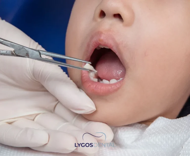 Permanent Tooth Before Baby Tooth Falls Out | LYGOS DENTAL 12 Permanent Tooth Before Baby Tooth Falls Out | LYGOS DENTAL