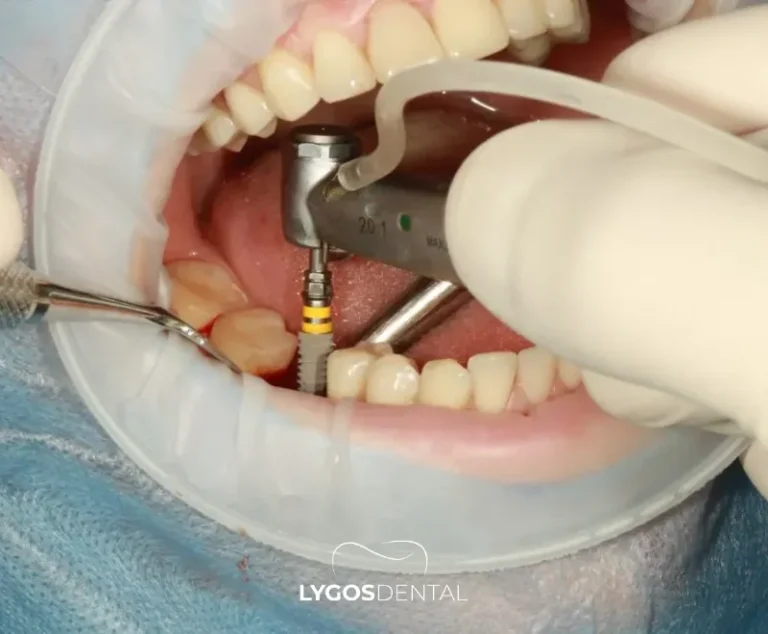 How Does Tooth Loss Affect Speech? | LYGOS DENTAL 9 How Does Tooth Loss Affect Speech? | LYGOS DENTAL