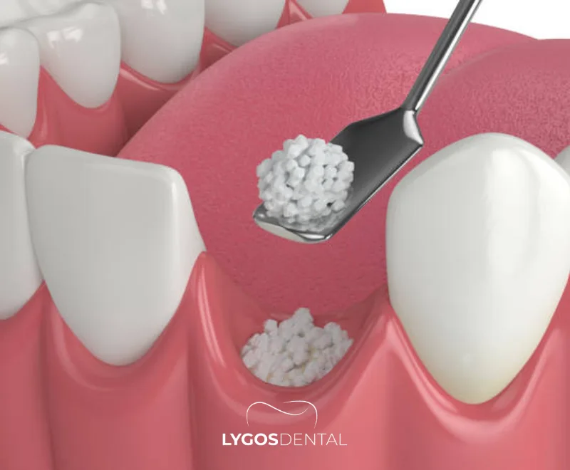 Use of Stem Cells in Dental Treatments | LYGOS DENTAL 4 Use of Stem Cells in Dental Treatments | LYGOS DENTAL