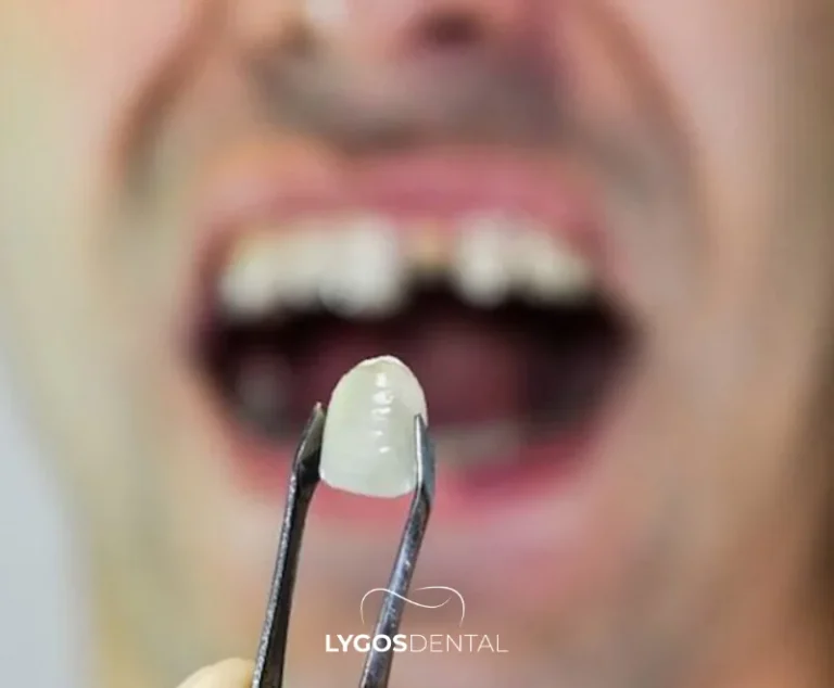 What to Do If a Dental Filling Falls Out | LYGOS DENTAL 27 What to Do If a Dental Filling Falls Out | LYGOS DENTAL