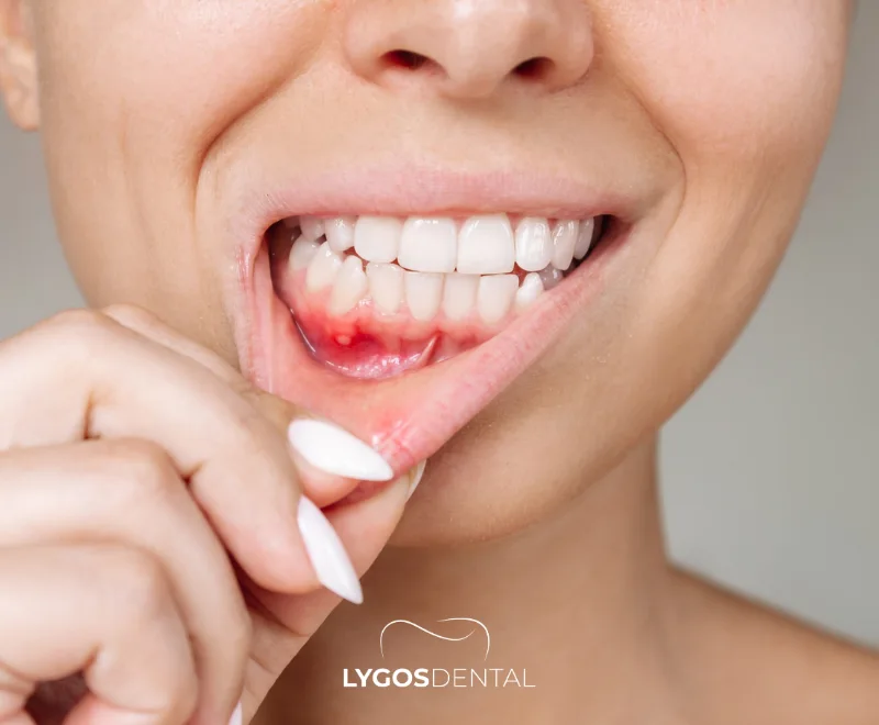 Natural Ways to Relieve Toothache | LYGOS DENTAL 22 Natural Ways to Relieve Toothache | LYGOS DENTAL