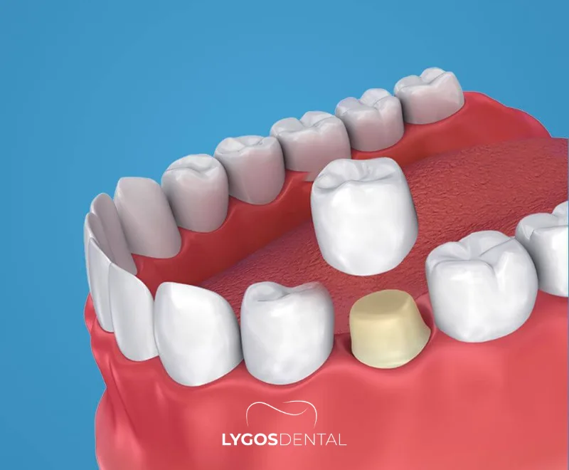 Aesthetic Advantages of Zirconium Crowns | LYGOS DENTAL 19 Aesthetic Advantages of Zirconium Crowns | LYGOS DENTAL