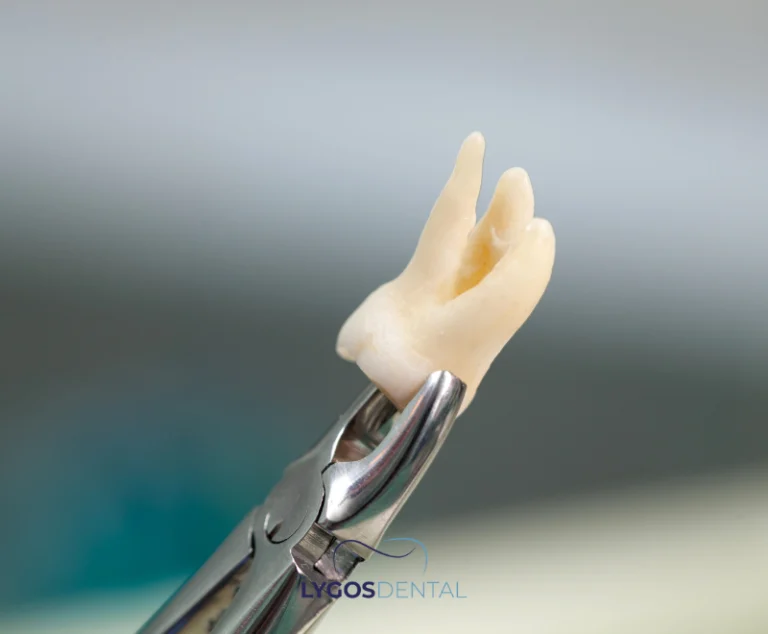 Cracked Tooth Syndrome | LYGOS DENTAL 14 Cracked Tooth Syndrome | LYGOS DENTAL