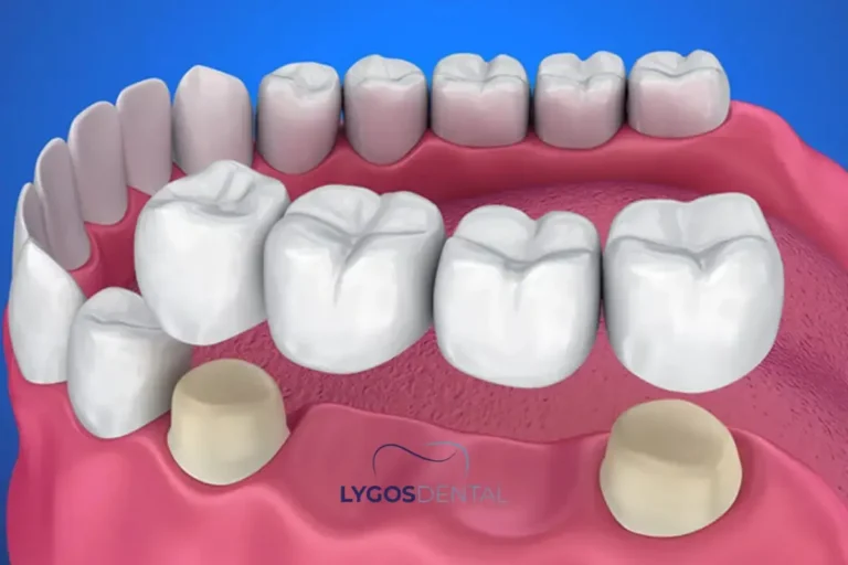 Dental Bridges Explained in Simple Terms