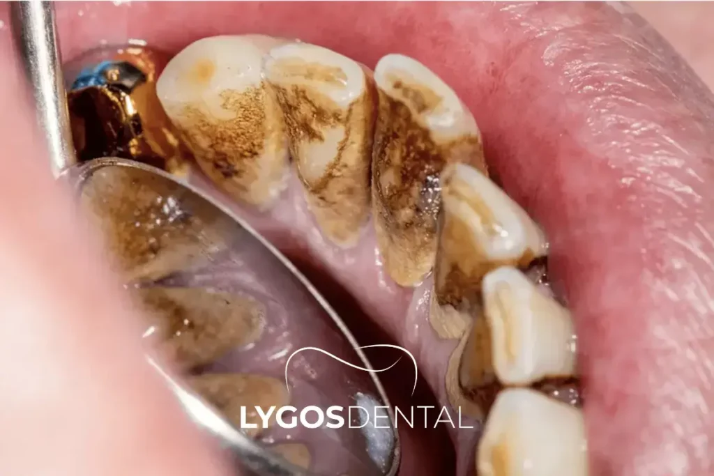 Why Black Lines Form on Teeth and How to Treat Them | LYGOS DENTAL 7 Common Causes of Black Lines on Teeth