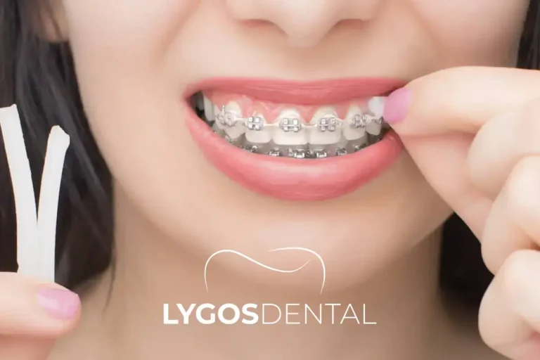 What Is Dental Wax and How to Use It? | LYGOS DENTAL 5 How to Use Dental Wax