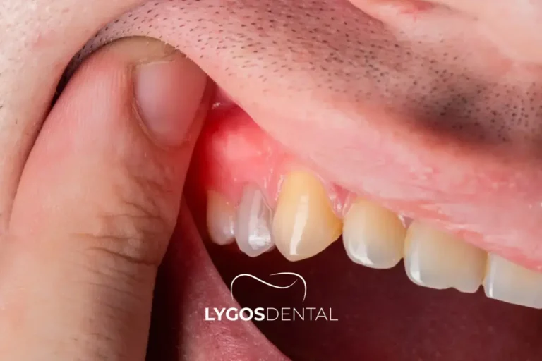 Signs that point toward gingivitis