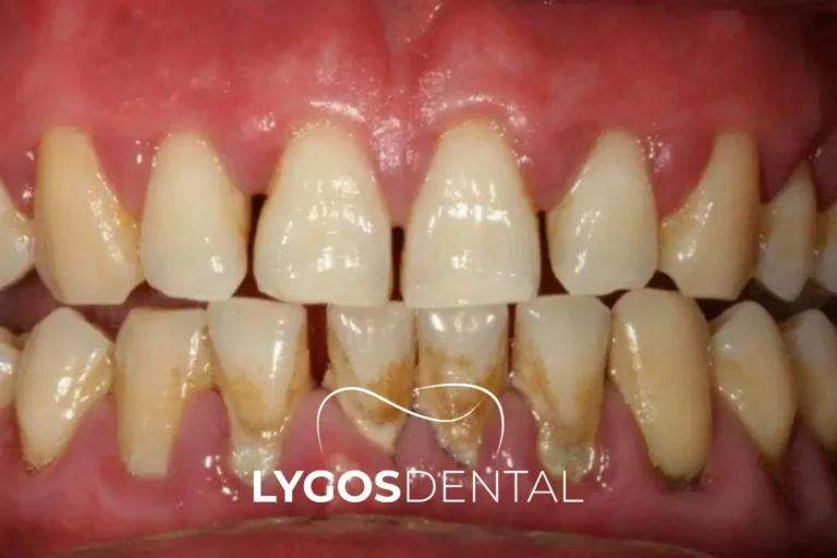 What Happens if You Skip Brushing for One Night