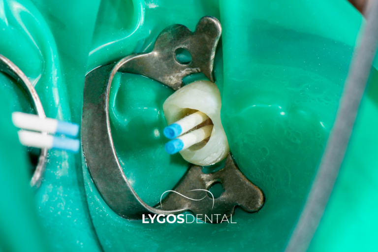 What a Root Canal Actually Involves