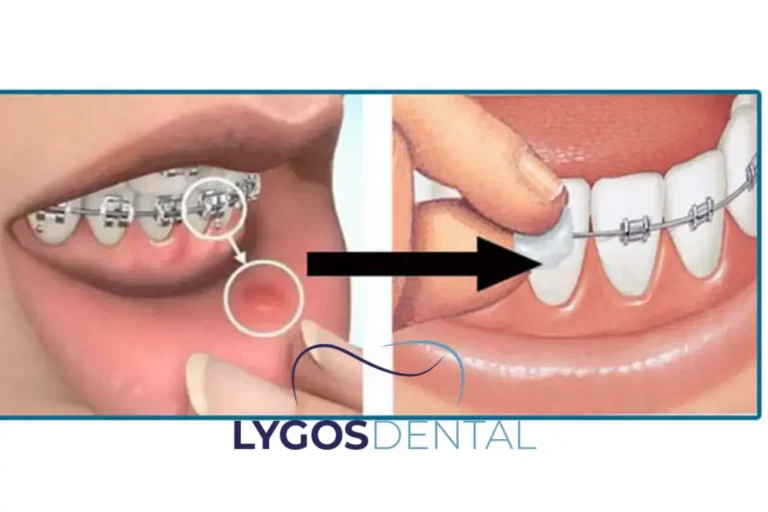 What Is Dental Wax and How to Use It? | LYGOS DENTAL 4 Why Do Dentists Use Dental Wax