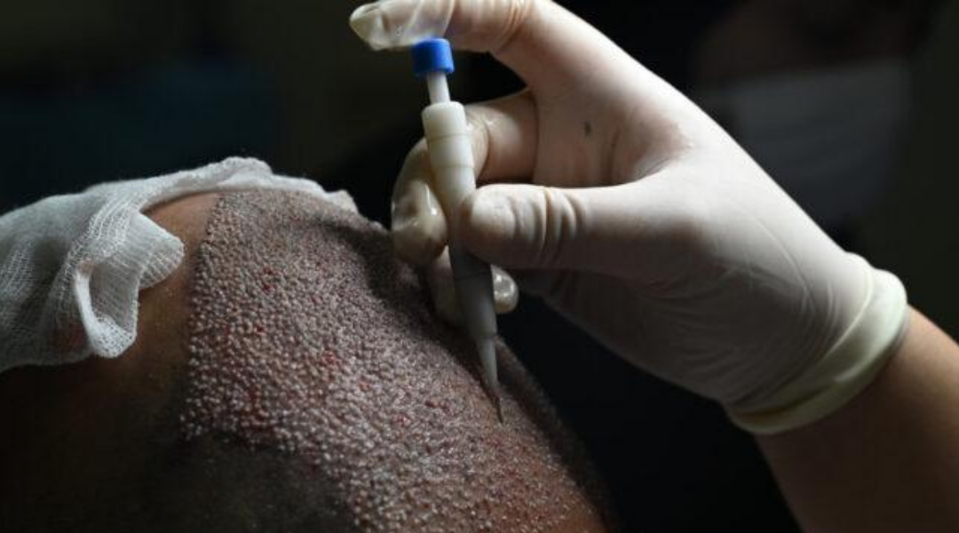 dhi hair transplant turkey