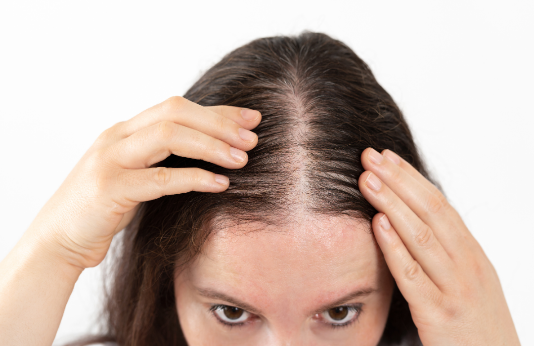 female hair loss