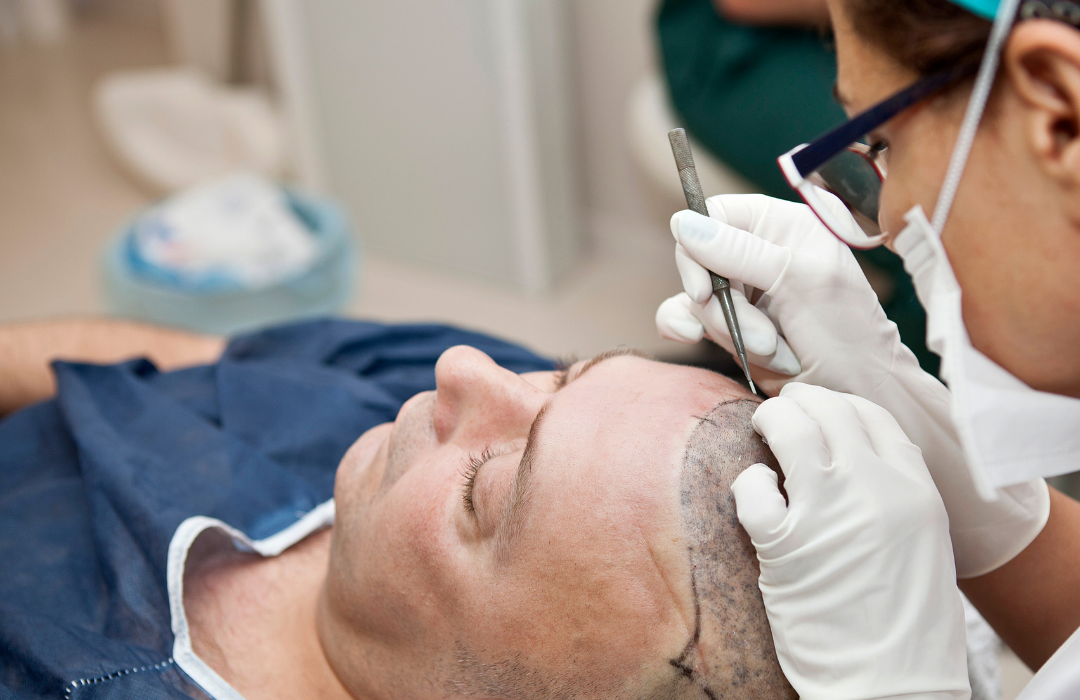 fue hair transplant 1