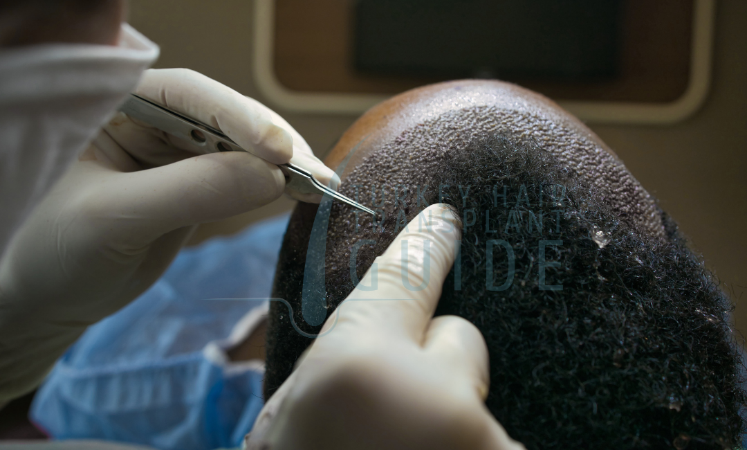 fue hair transplant