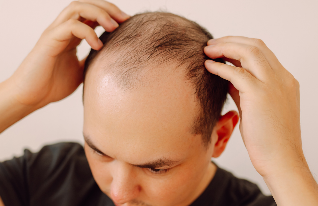 hair loss in men
