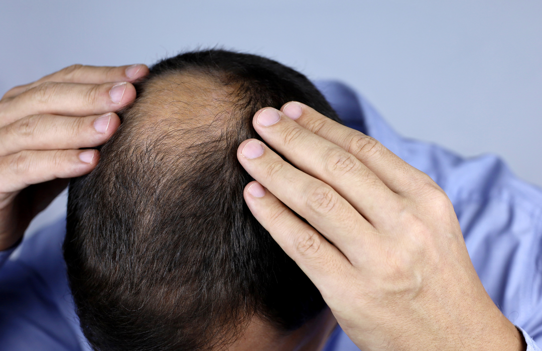 hair loss in men
